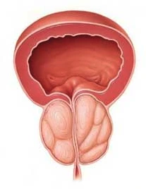 Schéma illustrant une prostate augmentée de volume